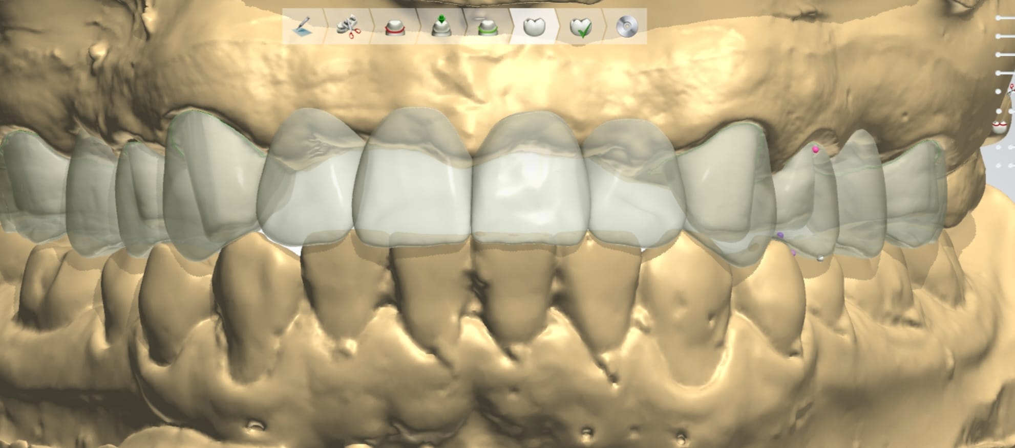 Anterior Crown & Bridge