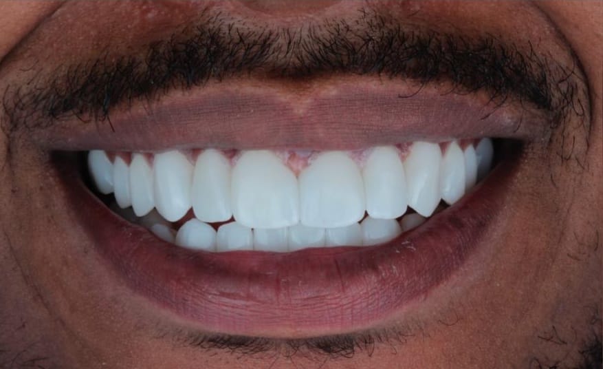 Laminates Smile Design